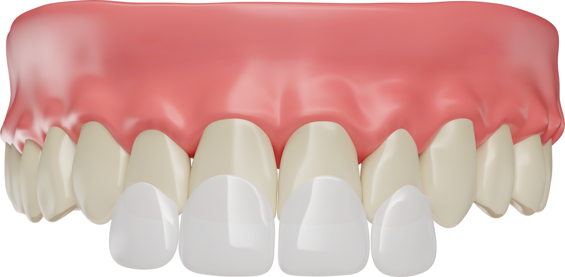 Teeth with lenses and gums 3d render