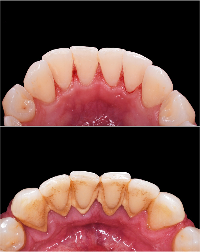 teeth cleaning and whitening before and after picture